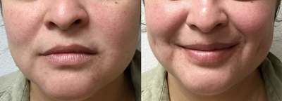 Lip Fillers before and after photo
