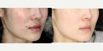 PicoWay before and after photo