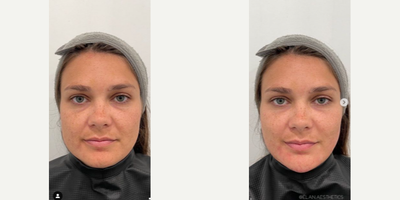 Sculptra before and after photo
