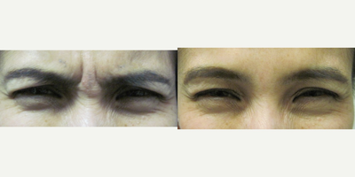 Botox before and after photo