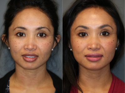 Botox before and after photo