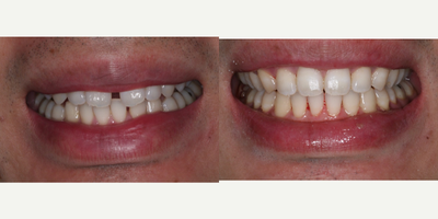 Braces before and after photo