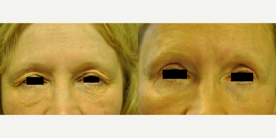 Eyelid Surgery before and after photo