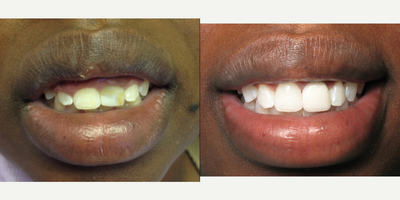 Gum Lift before and after photo