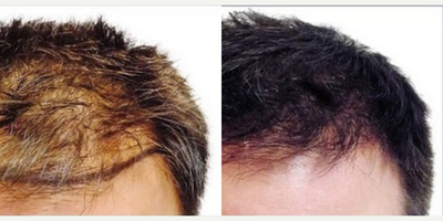 Hair Transplant before and after photo