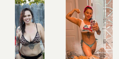 Liposuction before and after photo