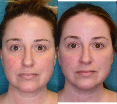 Restylane before and after photo