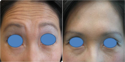 Botox before and after photo