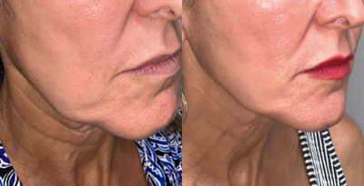 FaceTite before and after photo