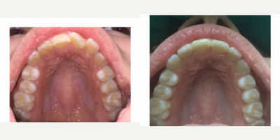 Invisalign before and after photo