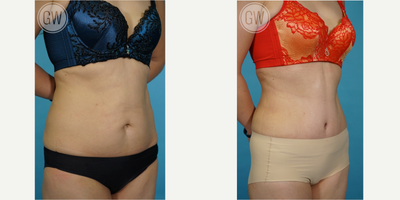Tummy Tuck before and after photo