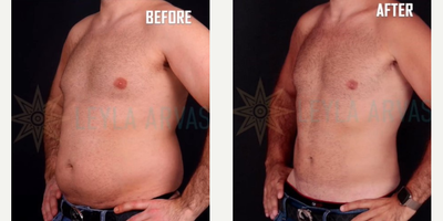 Vaser Liposuction before and after photo