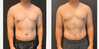 Abdominal Etching before and after photo