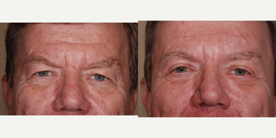 Eyelid Surgery before and after photo