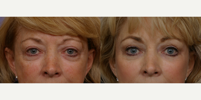Eyelid Surgery before and after photo