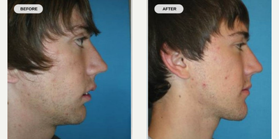 Jaw Surgery before and after photo