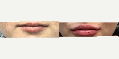 Lip Fillers before and after photo