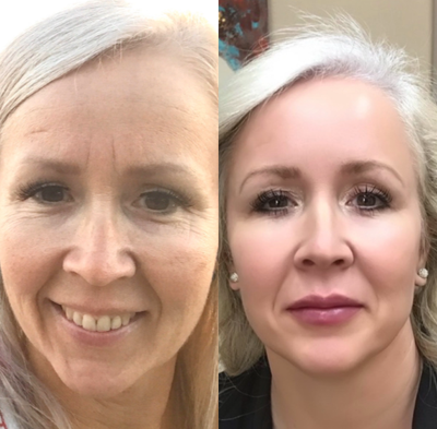 Microneedling before and after photo