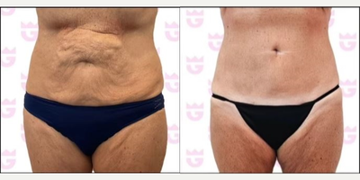 Tummy Tuck before and after photo
