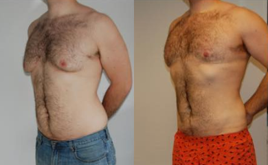 BodyTite before and after photo