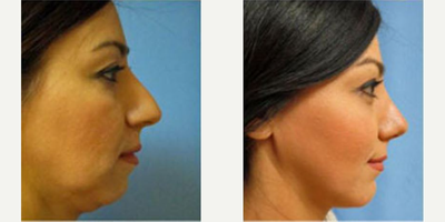 Facelift before and after photo