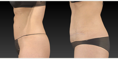 Tummy Tuck before and after photo