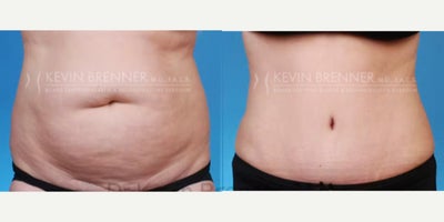 Tummy Tuck before and after photo