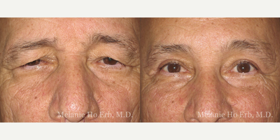 Brow Lift before and after photo