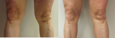 Liposuction before and after photo