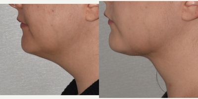 Liposuction before and after photo