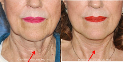 Neck Lift before and after photo