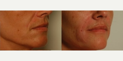 Radiesse before and after photo
