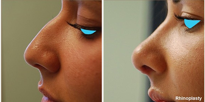 Rhinoplasty before and after photo