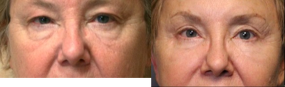 Brow Lift before and after photo