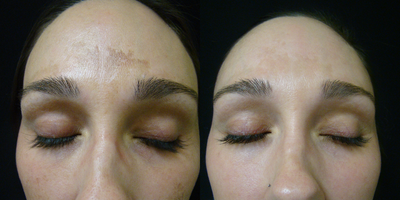 Chemical Peel before and after photo