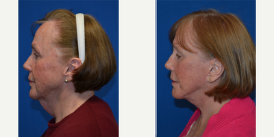 Deep Plane Facelift before and after photo