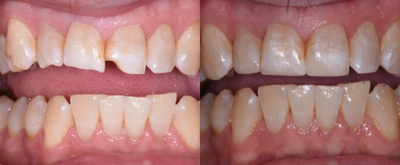 Dental Bonding before and after photo