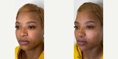 Dermal Fillers before and after photo