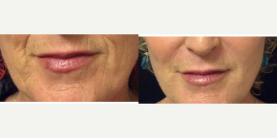 Juvederm before and after photo