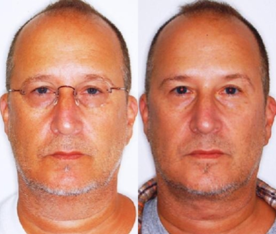 Neck Lift before and after photo