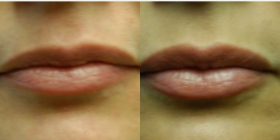 Restylane before and after photo