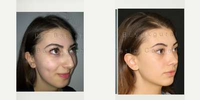 Rhinoplasty before and after photo