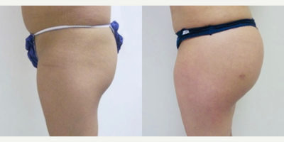 Brazilian Butt Lift before and after photo