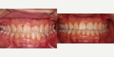 Clear Braces before and after photo