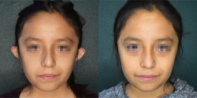 Ear Surgery before and after photo