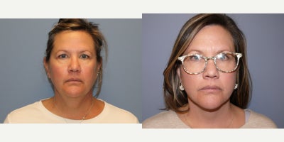 Facelift before and after photo