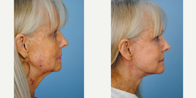 Facial Fat Transfer before and after photo