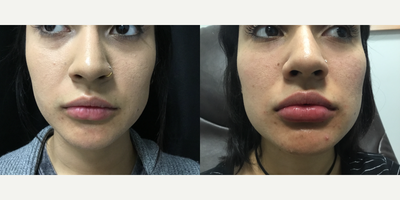 Juvederm before and after photo