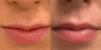 Volbella before and after photo