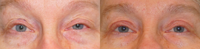 Eyelid Surgery before and after photo